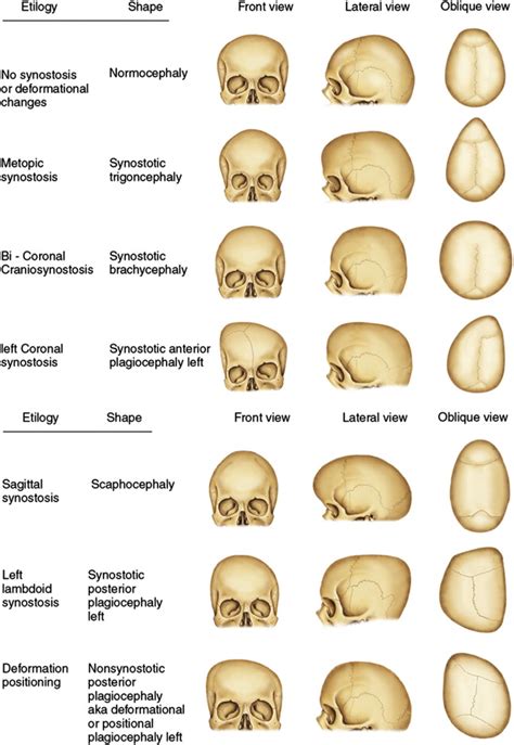 abnormal skull shapes.